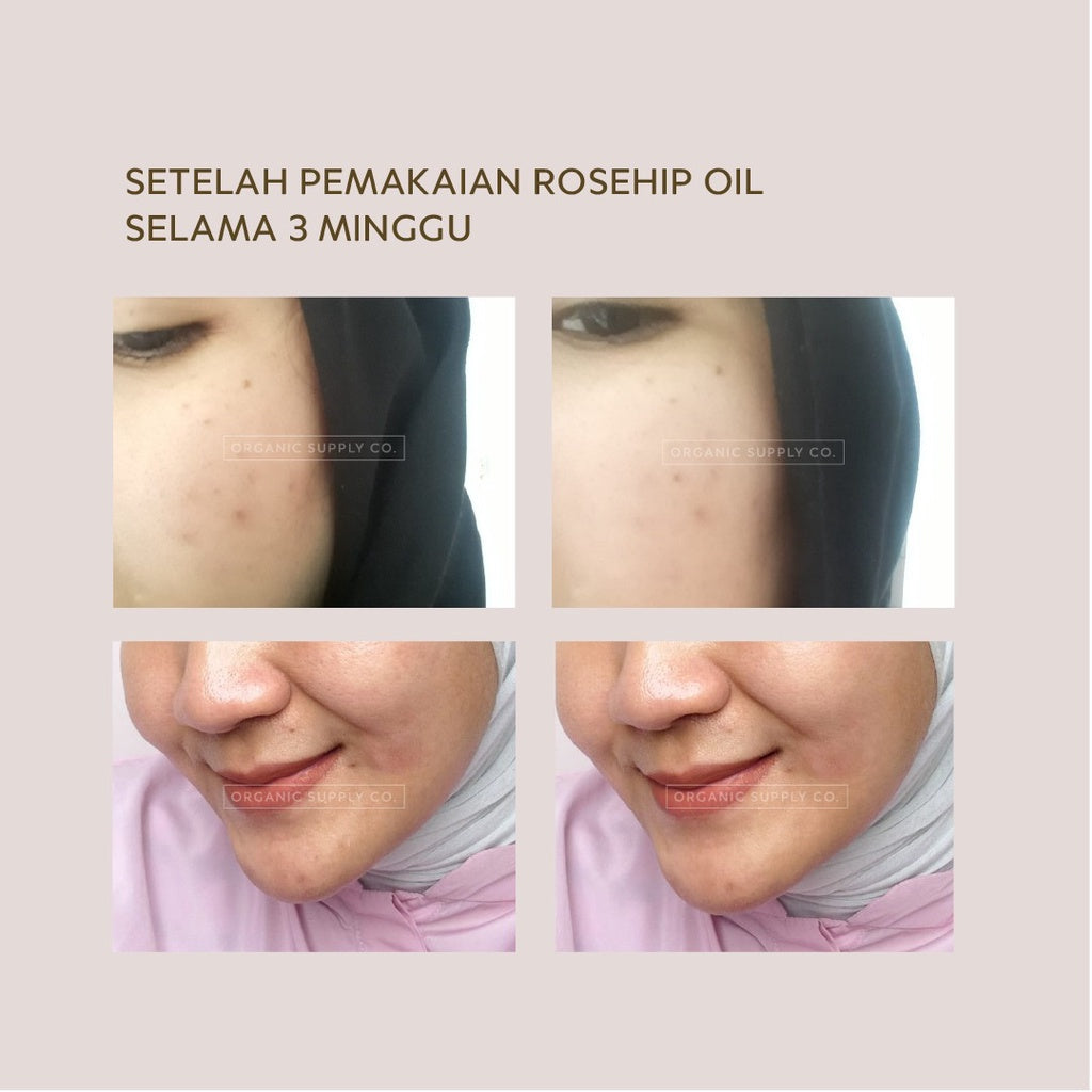 Rosehip Oil Advanced Formula